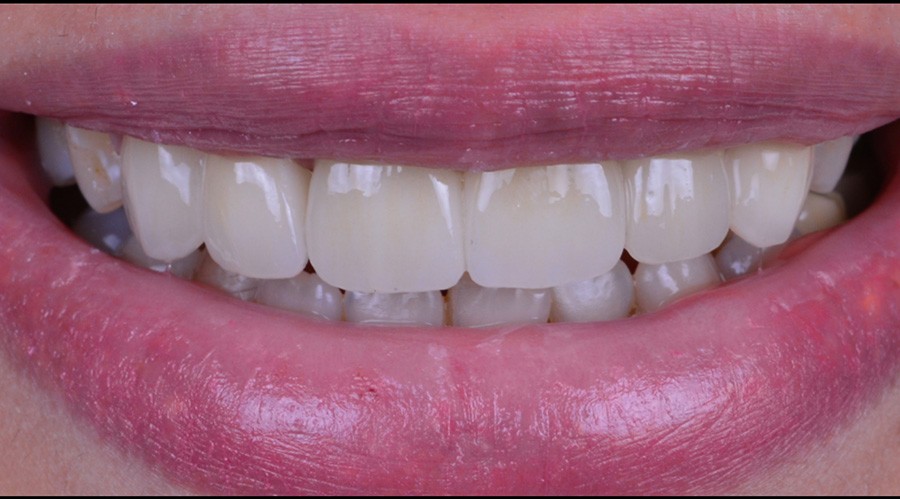 قبل تركيبات-اسنان